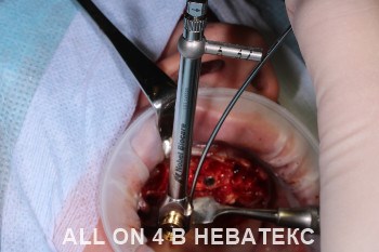 имплантация all-on-4 фото операции имплантация all-on-4 фото операции